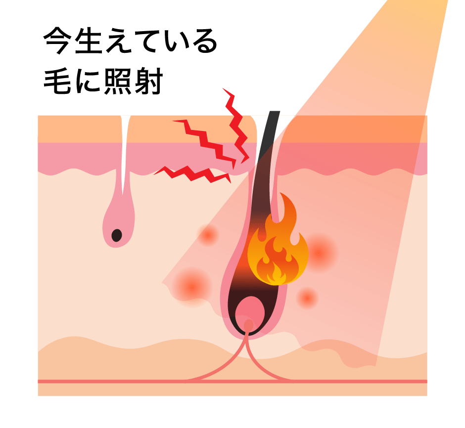 今生えている毛に照射