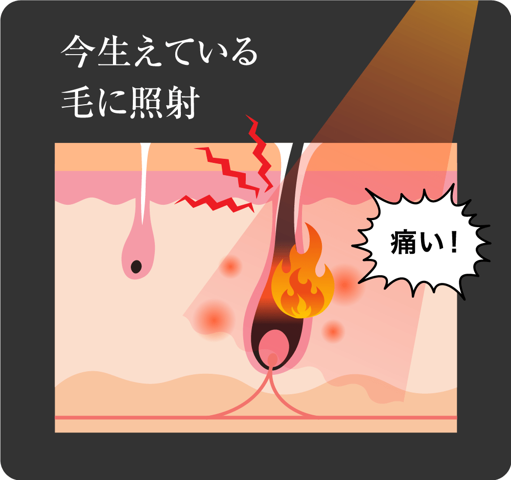 今生えている毛に照射